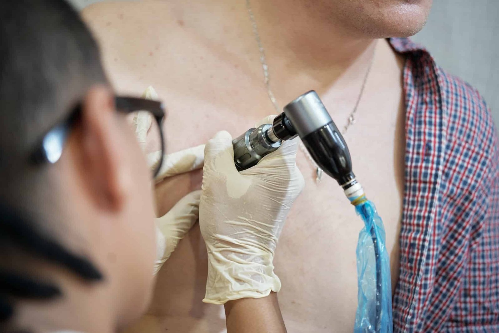 Laser Tattoo Removal