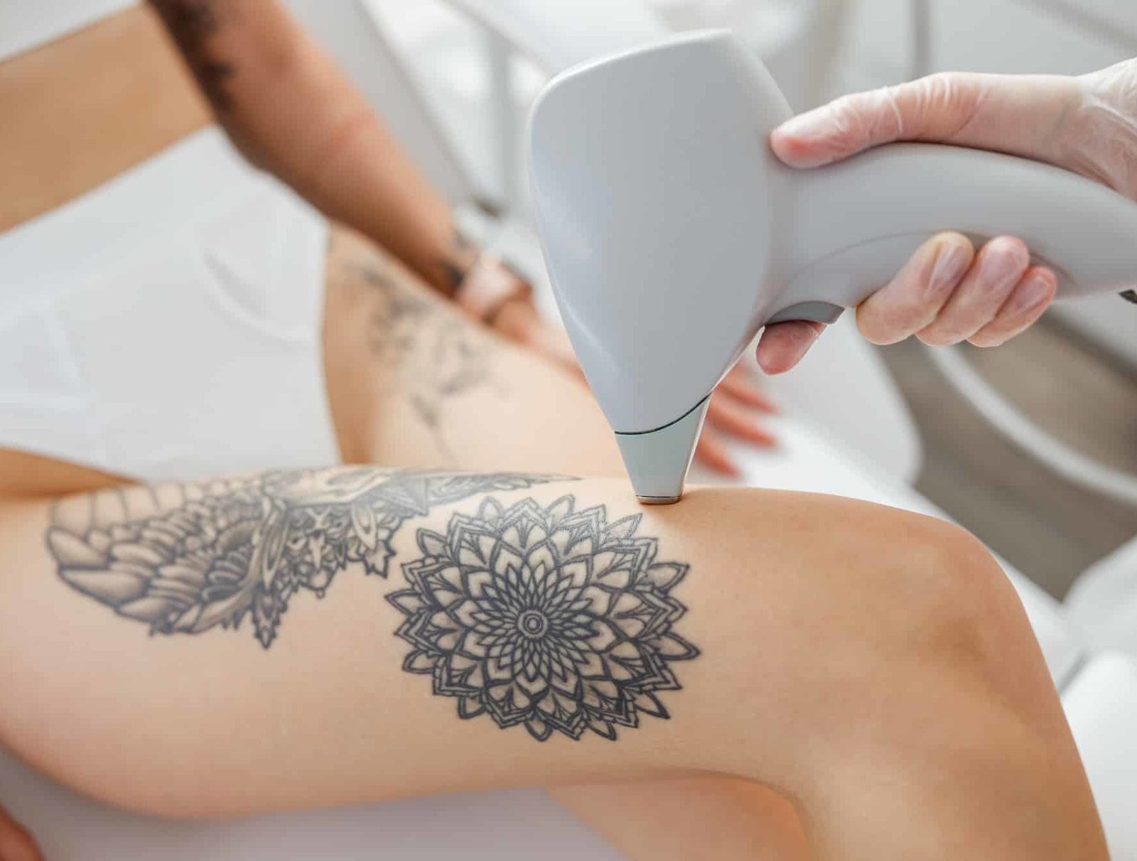 Understanding Laser Tattoo Removal